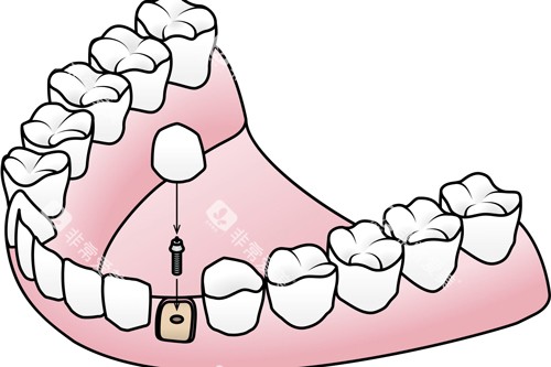 种植牙安装牙冠卡通图