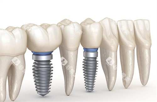 种植牙动画图片展示