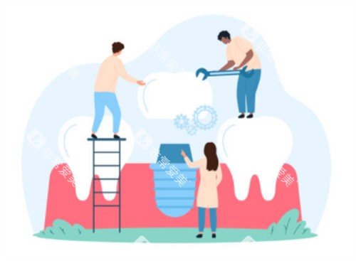 种植牙卡通示意