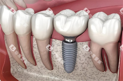 种植牙动画示图