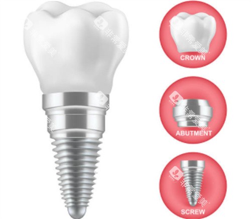 种植牙的三部分