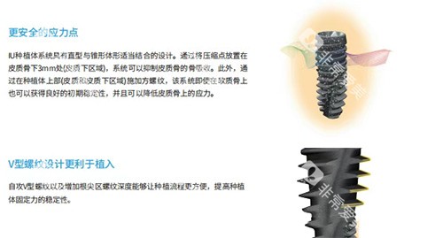 韩国沃兰种植牙优势图片
