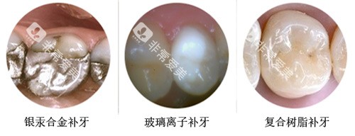 补牙材料示意图