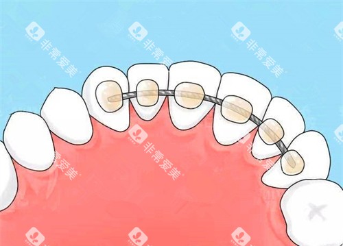 牙齿矫正舌侧保持器