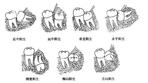 智齿各种阻生示意图