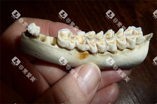 假牙模型展示