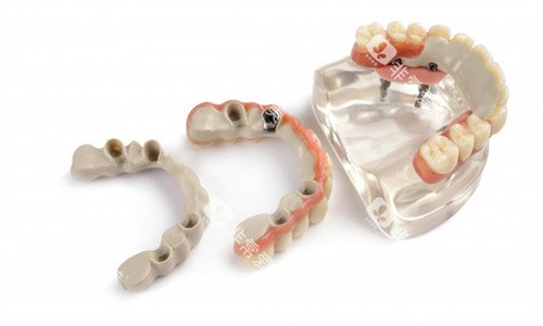 peek支架假牙制作成品