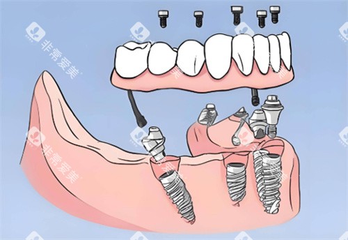 全口种植牙卡通图片