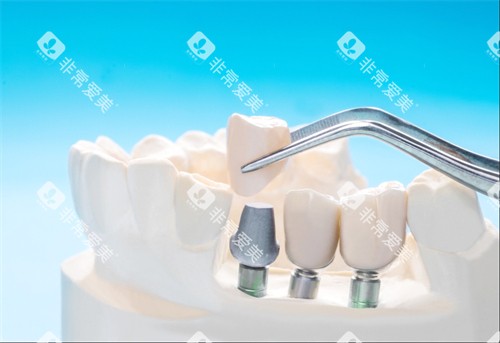 种植牙动画 种植牙动画