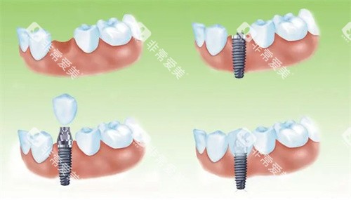 种植牙过程 种植牙过程