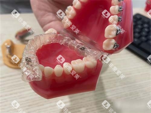 牙齿矫正隐形牙套模型 牙齿矫正隐形牙套模型
