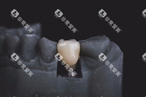 牙齿修复示意图