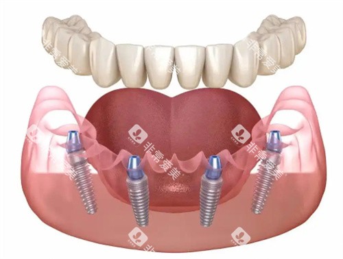 种植牙展示卡通图 种植牙展示卡通图