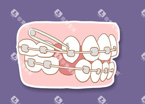 牙齿收缝卡通图片