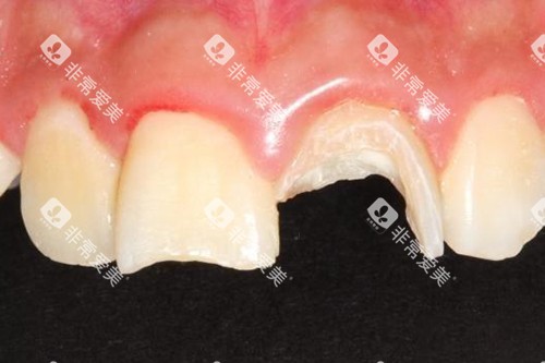 牙齿摔断实拍示意图