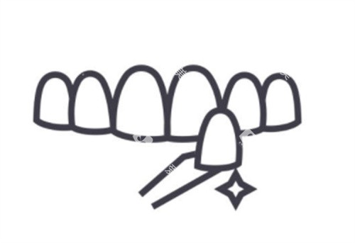 牙齿贴面卡通图