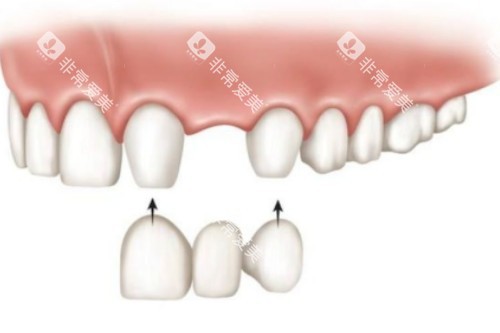 镶牙安装卡通图