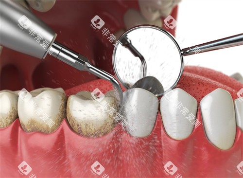 正在进行洗牙 正在进行洗牙