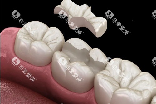 嵌体补牙卡通图 嵌体补牙卡通图