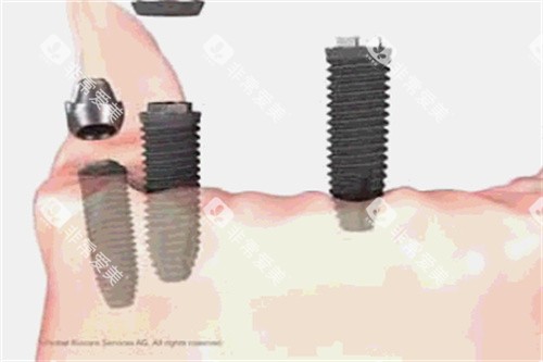 种植牙操作细节