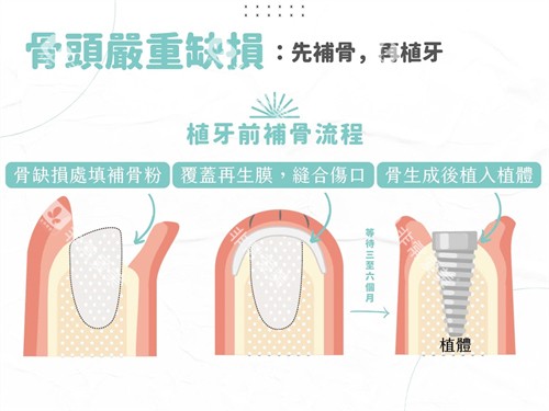 种植牙植骨与植体植入过程漫画图