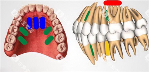 牙齿矫正方案设计