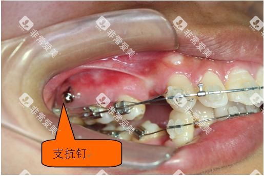 牙齿矫正骨钉种植钉口腔示意图