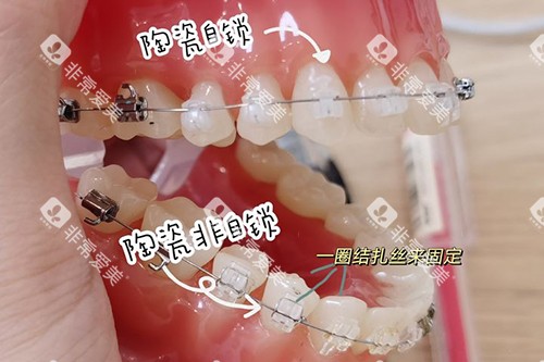 牙齿矫正陶瓷自锁托槽和非自锁牙套