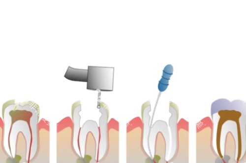 根管治疗卡通步骤图