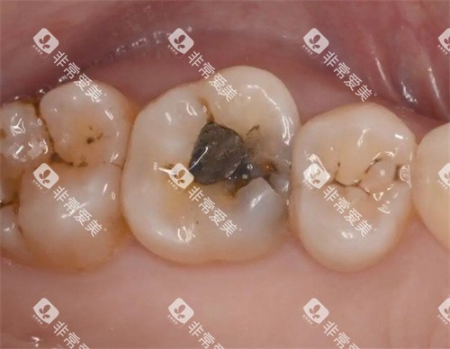 牙齿龋坏照片