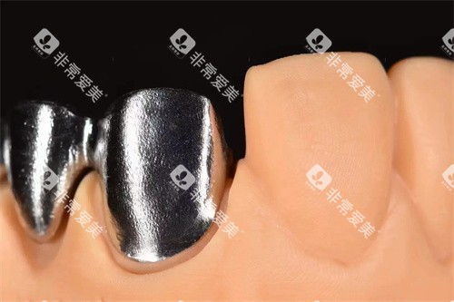 义佳微纳熔覆义齿实物图