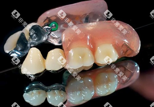 半固定义齿照片