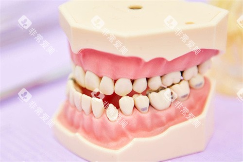 反颌牙齿模型