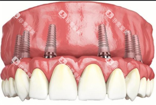 全口种植牙动画示意图