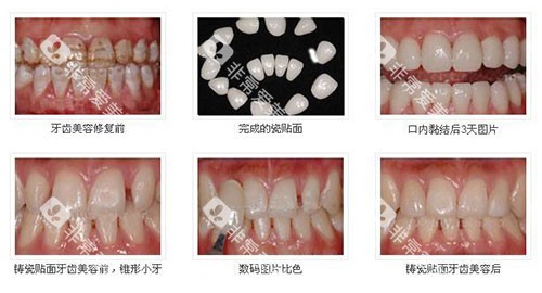 不同方式牙齿美白示意图 不同方式牙齿美白示意图