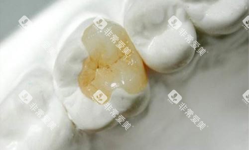 嵌体补牙后展示图