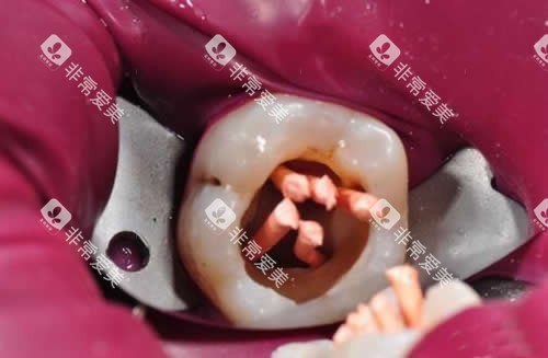 根管治疗细节图片