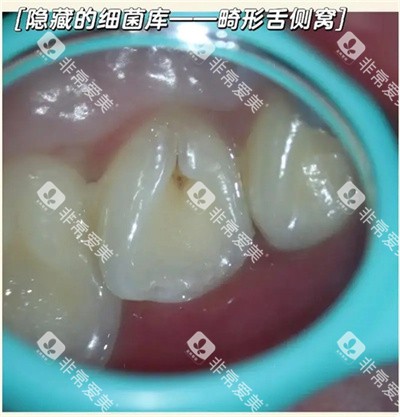 畸形舌侧窝牙齿展示图 畸形舌侧窝牙齿展示图