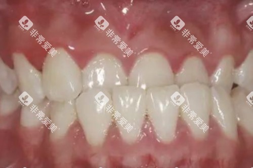 牙齿地包天卡通图 牙齿地包天卡通图