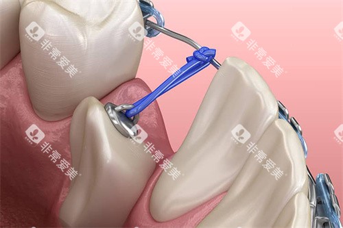 下颌单颗牙齿牵引 下颌单颗牙齿牵引