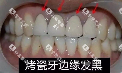 烤瓷牙边缘发黑