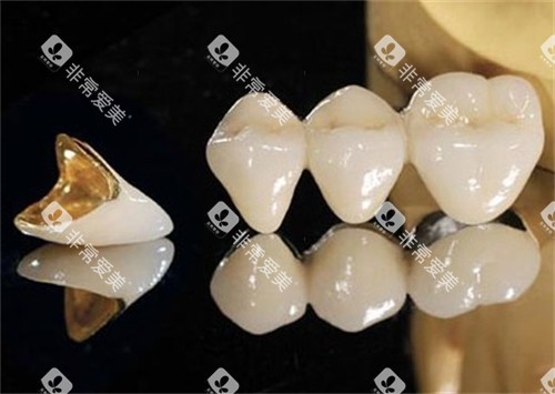 单颗烤瓷牙和连冠烤瓷牙