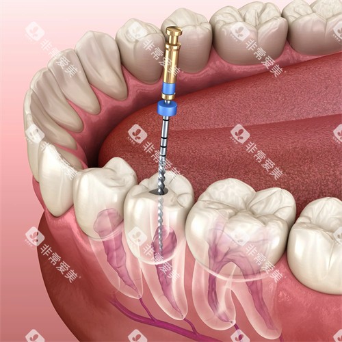 根管治疗示意图展示