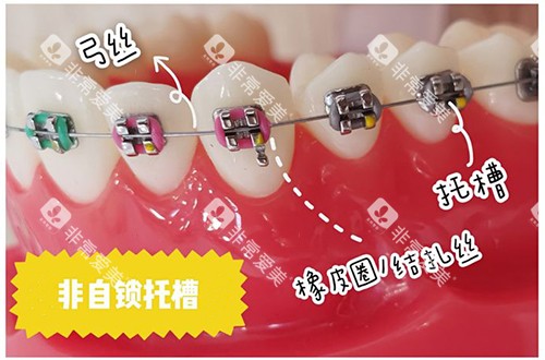牙齿矫正非自锁托槽 牙齿矫正非自锁托槽
