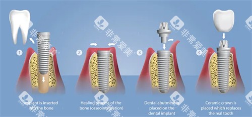 种植牙手术流程图