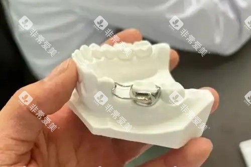 儿童牙齿间隙保持器