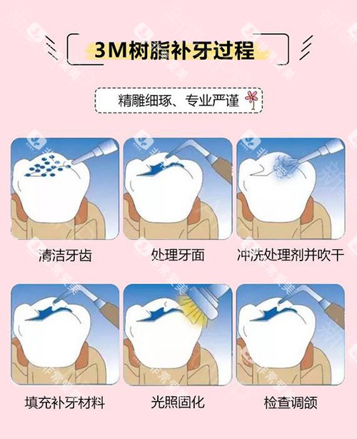 3M树脂补牙过程