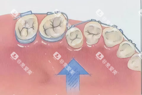 牙齿矫正示意图