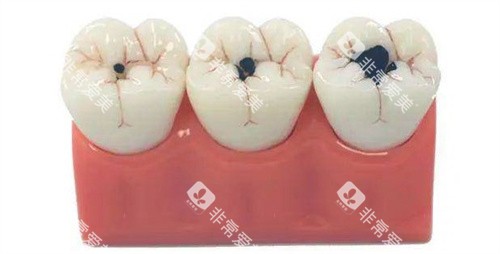 补牙的大小对比