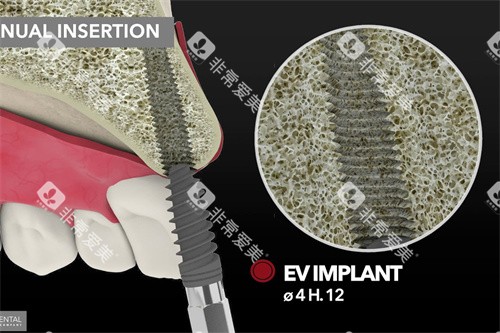 意大利BB种植牙上颌种植